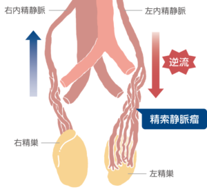 男性不妊の原因になる精索静脈瘤 精巣上体炎とクラミジアの関係 性病検査navi